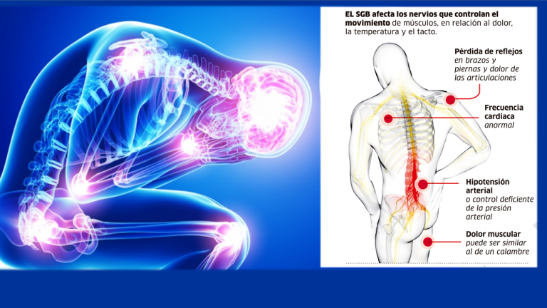¿Cómo podemos prevenir el Guillian – Barré?