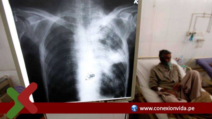 Subsisten deficiencias preocupantes en la atención a las personas viviendo con VIH que tienen tuberculosis