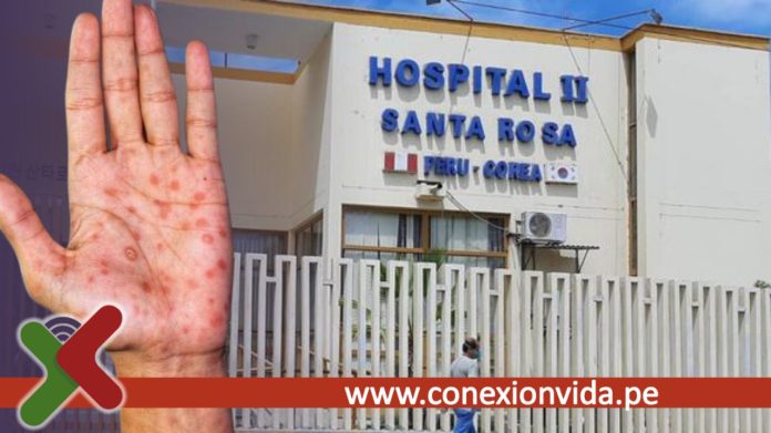 Viruela del Mono detecta posible primer caso en el Perú