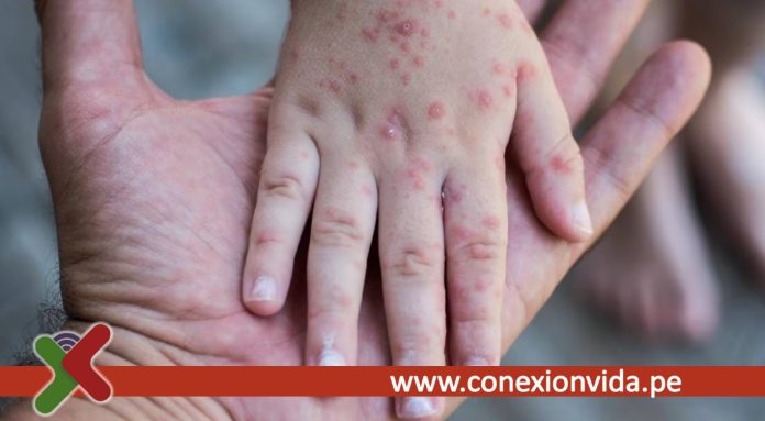 Casos de Sarampión en Perú Minsa detecta contagio en niña de 10 meses